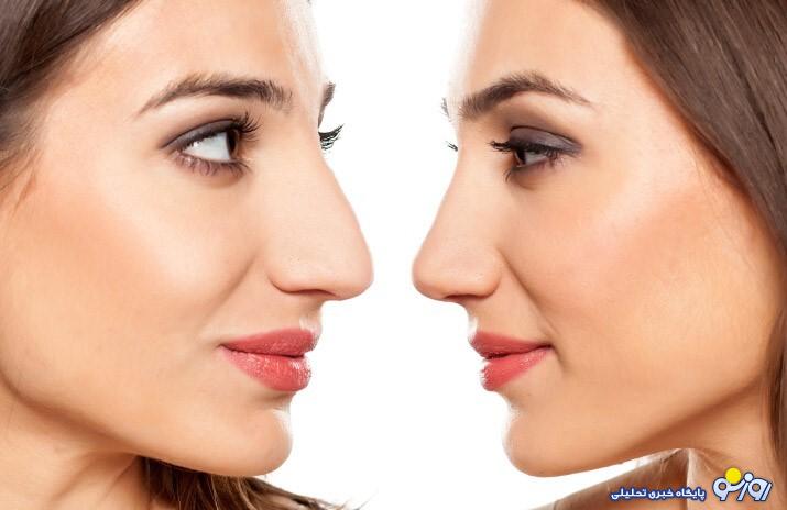 عمل رینوپلاستی چیست و چرا هر ساله میلیون‌ها نفر به سراغ آن می‌روند؟